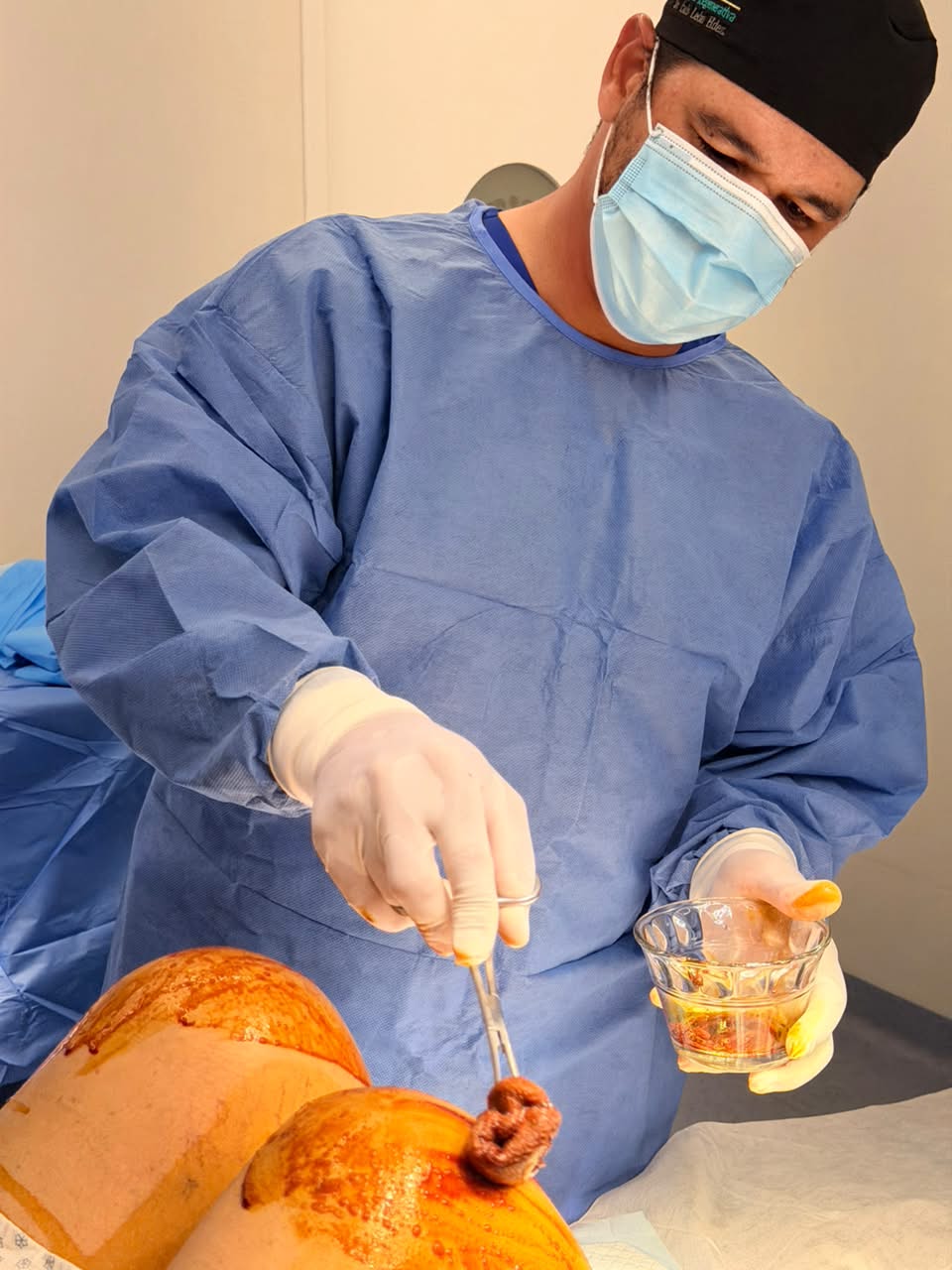Material preparado para micronizado de tejido adiposo